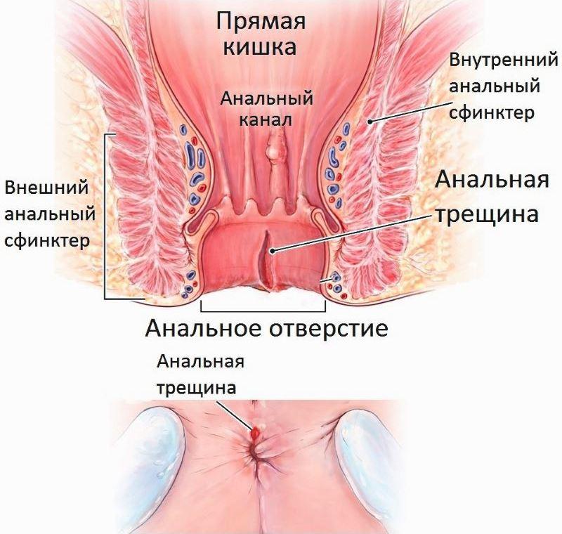 Hemorrhoid herpes anus